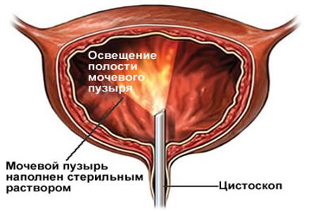 Схема уретроцистоскопии