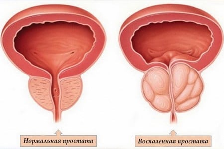 Воспаленная простата