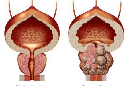 Нормальная простата и аденома простаты