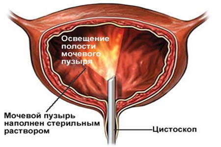 Схема уретроцистоскопии Схема уретроцистоскопии