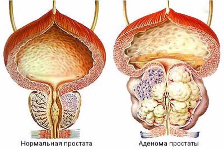 Рисунок нормальной и воспалённой простаты Рисунок нормальной и воспалённой простаты
