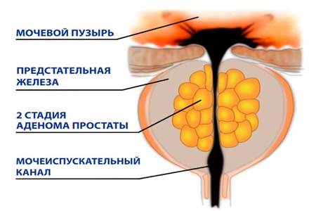 Схема II-й стадии гиперплазии Схема II-й стадии гиперплазии