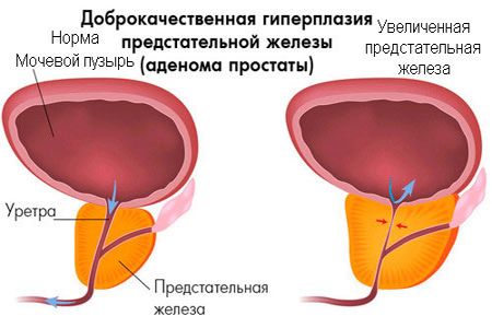 Препараты при хроническом простатите у мужчин