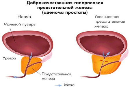 Массаж простаты обязателен при лечении простатита