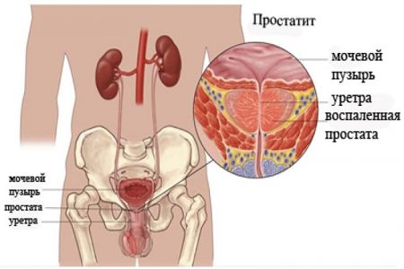 Лечение рака простаты солью
