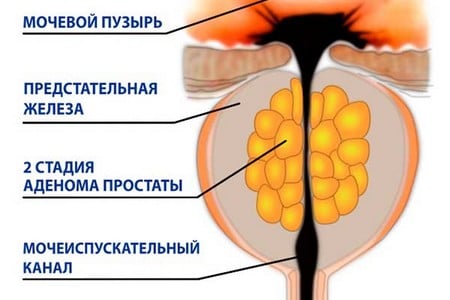 Лечение хронического простатита быстро лекарством