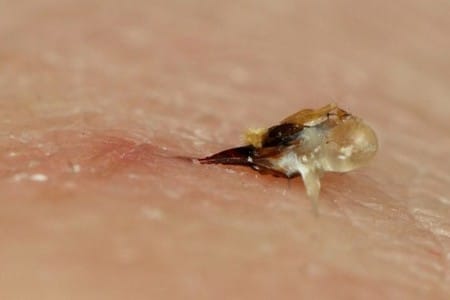 Жало пчелы в коже человека Жало пчелы в коже человека