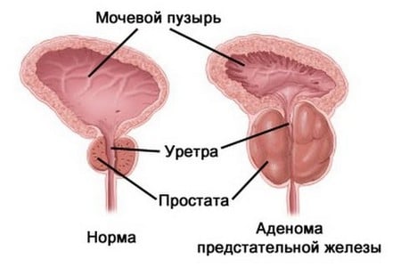 Схематическое изображение аденомы предстательной железы Схематическое изображение аденомы предстательной железы