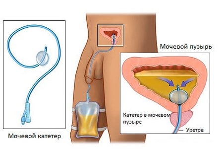 Народное средство для профилактики простатита