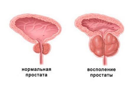 Нормальная и воспаленная простата Нормальная и воспаленная простата