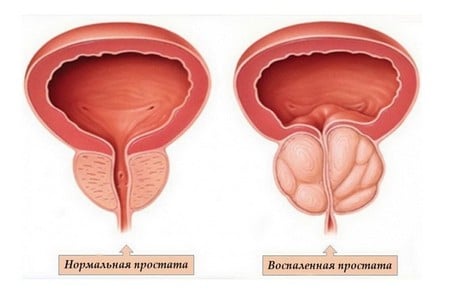 Нормальная и воспаленная простата Нормальная и воспаленная простата