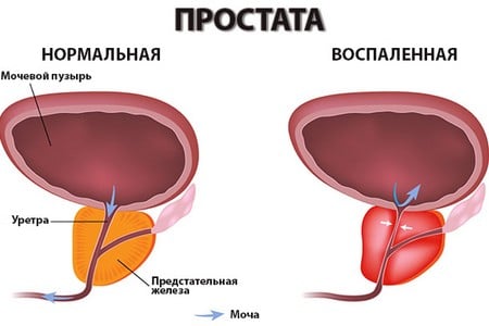 простата простата