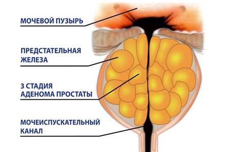 заболевание простаты заболевание простаты