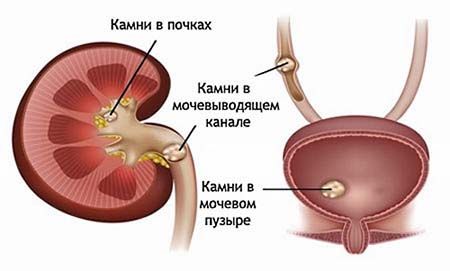 Удаление простаты последствия операции отзывы