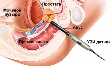 Какие анализы способы диагностировать геморрой вовремя