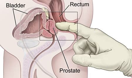 нормальная и воспаленная простата