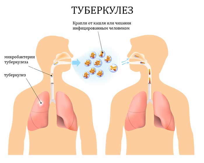 Пути заражения туберкулезом предстательной железы