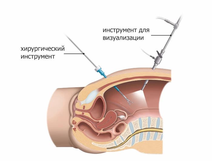 Схема лапараскопической операции при аденоме простаты