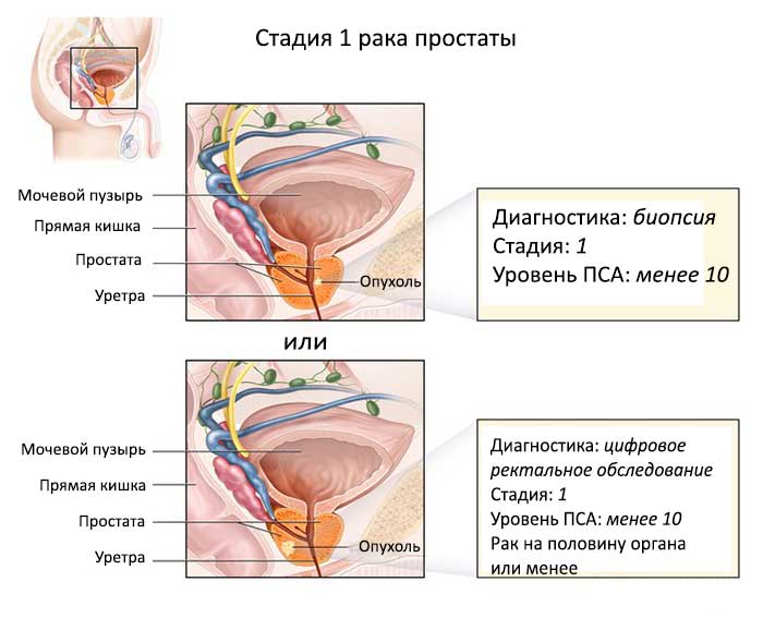 Схема-рака-простаты-1-стадии
