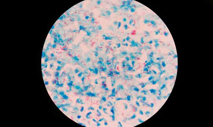 Туберкулез простаты под микроскопом