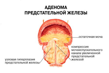 Схема узловой гиперплазии