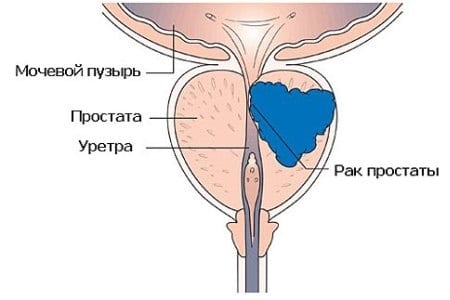Анализ простатического сока (секрета предстательной железы) у мужчин