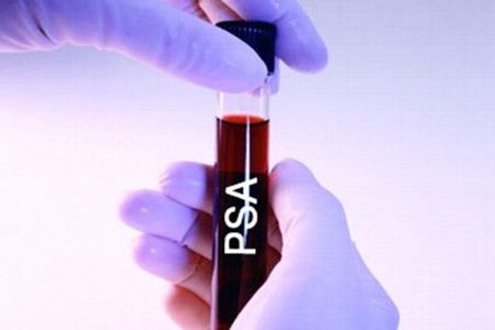 Анализ крови на ПСА в пробирке