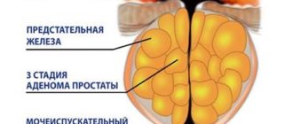 О симптомах, причинах и лечении аденомы предстательной железы у мужчин