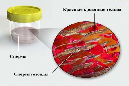 Рисунок изображающий кровь в пробе спермы