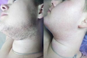 Лазерная эпиляция бороды до и после - фото 1