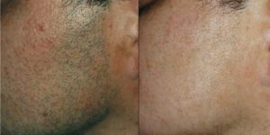 Лазерная эпиляция бороды до и после - фото 2