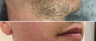 Лазерная эпиляция бороды у мужчин и женщин