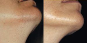 Лазерная эпиляция бороды до и после - фото 4