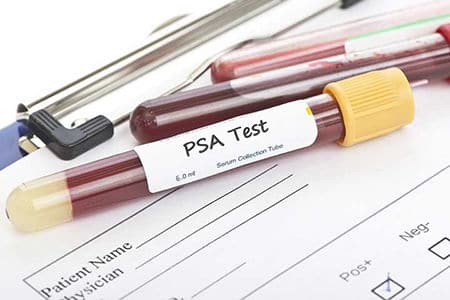 Расшифровка и нормы ПСА крови при аденоме предстательной железы