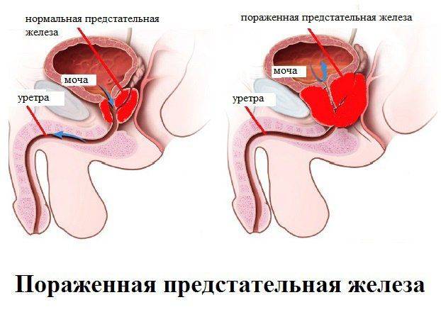 shema vospaleniya prostaty