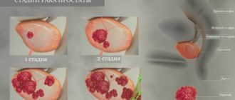 Рак предстательной железы 2 стадии