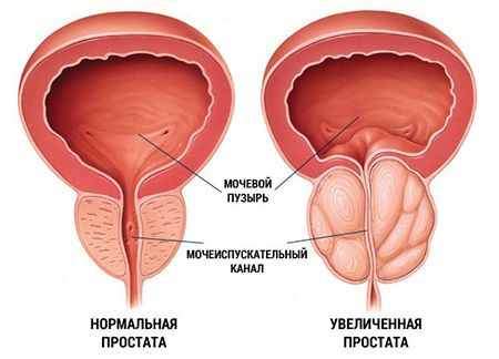 нормальная и увеличенная простата